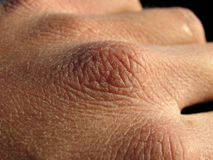 اضغط على الصورة لعرض أكبر.&nbsp;

الإسم:	dry_skin.jpg&nbsp;
مشاهدات:	1&nbsp;
الحجم:	18.3 كيلوبايت&nbsp;
الهوية:	848352