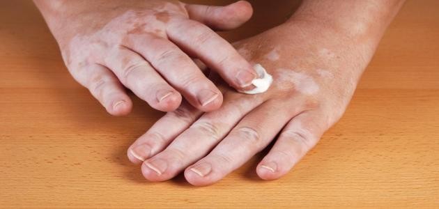 اضغط على الصورة لعرض أكبر.&nbsp;

الإسم:	_عن_مرض_البرص.jpg&nbsp;
مشاهدات:	791&nbsp;
الحجم:	33.1 كيلوبايت&nbsp;
الهوية:	887215