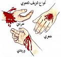 اضغط على الصورة لعرض أكبر. 

الإسم:	externalhemoragy.jpg 
مشاهدات:	1862 
الحجم:	15.0 كيلوبايت 
الهوية:	826243