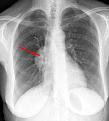 اضغط على الصورة لعرض أكبر. 

الإسم:	thymoma.jpg 
مشاهدات:	4587 
الحجم:	16.4 كيلوبايت 
الهوية:	826615