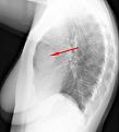 اضغط على الصورة لعرض أكبر. 

الإسم:	thymoma_lateral.jpg 
مشاهدات:	3982 
الحجم:	14.5 كيلوبايت 
الهوية:	826616