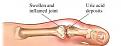 اضغط على الصورة لعرض أكبر. 

الإسم:	gout_h2.jpg 
مشاهدات:	12066 
الحجم:	11.4 كيلوبايت 
الهوية:	843753