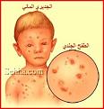 اضغط على الصورة لعرض أكبر. 

الإسم:	Varicella02.jpg 
مشاهدات:	968 
الحجم:	12.6 كيلوبايت 
الهوية:	844649